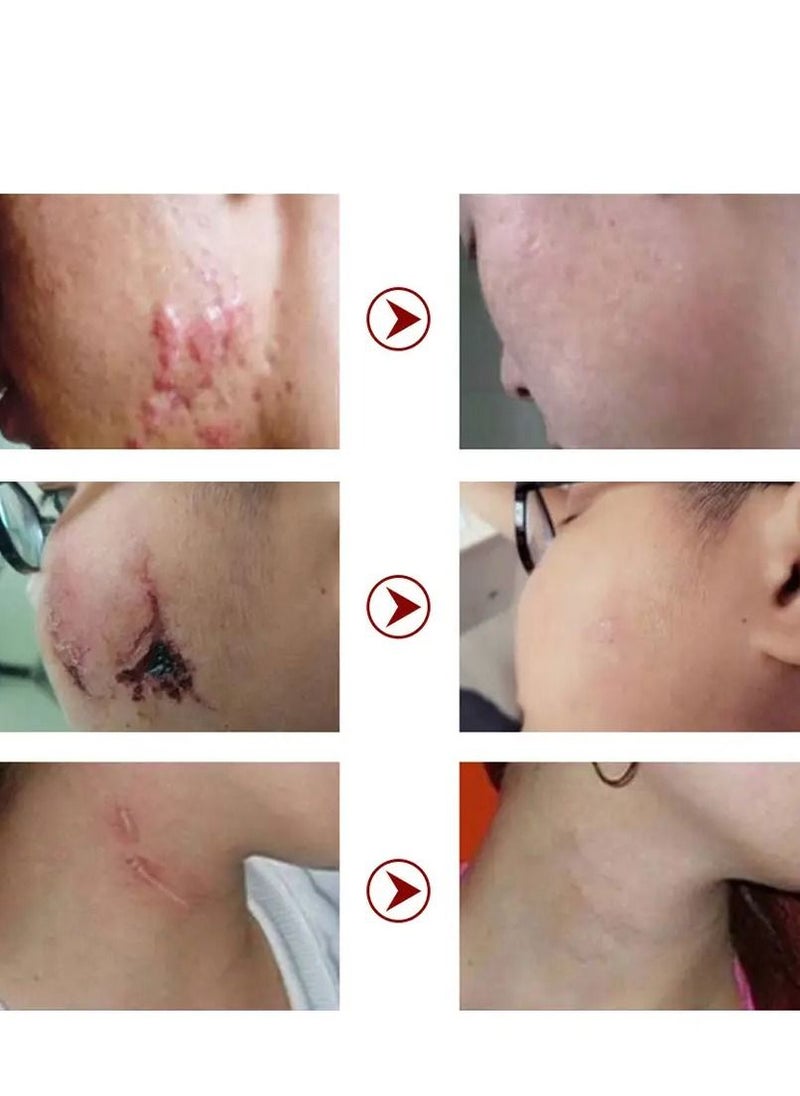 MOOYAM - Scar Removal Cream Acne Scar Cream Rapid Repair Scar Cream for Acne Surgery Injury Burns Advanced Gel Acne Scar Spot Treatment Suitable for All Skin Types 30g - Image 1