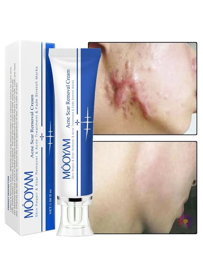 MOOYAM - Scar Removal Cream Acne Scar Cream Rapid Repair Scar Cream for Acne Surgery Injury Burns Advanced Gel Acne Scar Spot Treatment Suitable for All Skin Types 30g - Image 1