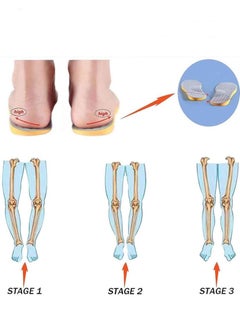 Furtey O-shaped Legs XO-shaped Legs Correction Insole Breathable Orthotic PU Shoe Inserts Suitable for adults Strong Support the Feet Relief Foot Fatigue  - Image 3