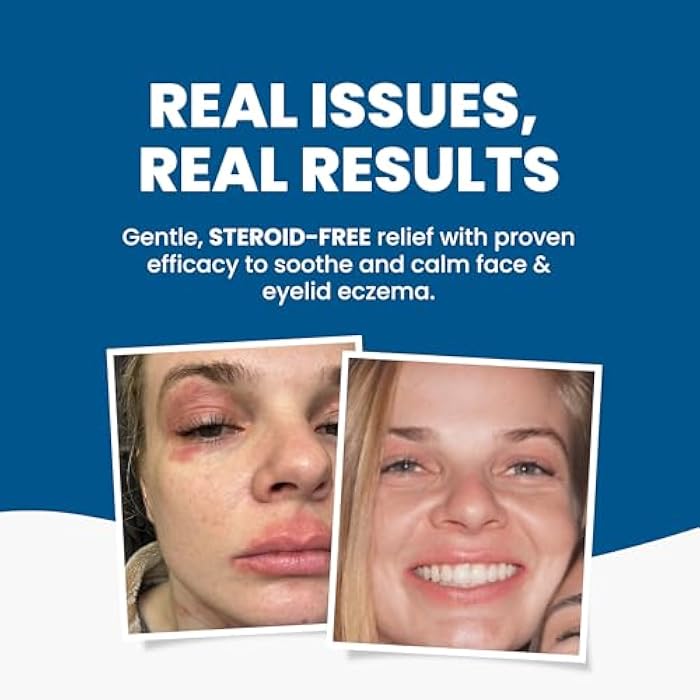 Grahams Natural Face & Eyelid Oil - For Very Dry Skin Around Eye & Face, Eczema & Perioral Dermatitis - Steroid-Free, Hypoallergenic, Non-Comedogenic - 100% Pure - with Argan & Jojoba Oil (1.69 Fl Oz) - Image 2