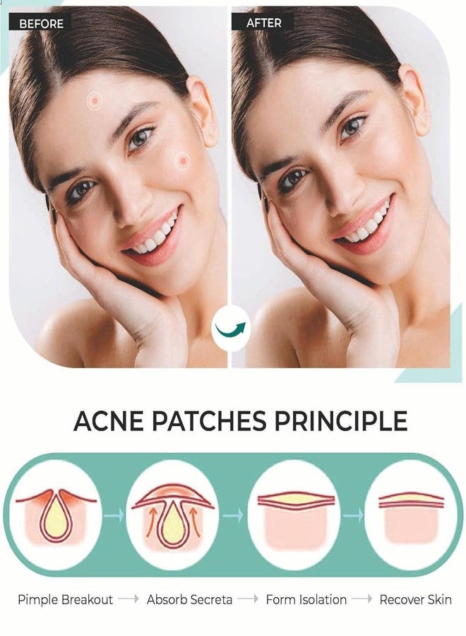 Peace Tech Acne Pimple Patch | 72 pcs of Hydrocolloid Waterproof Patches | For Active Surface Acne | Absorbs Pimple Overnight, Reduces Excess Oil | For All Skin Types - Image 4