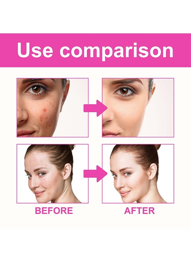 EELHOE 160Pcs Pimple Patches for Face,Hydrocolloid Acne Patches for Covering Zits and Blemishes, Cute Spot Stickers for Skin Care - Image 4