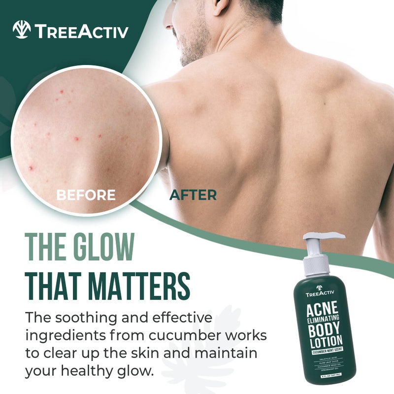 TreeActiv Acne Eliminating Body Lotion 8 fl oz | Clears Body, Back, Butt and Shoulder Acne | Anti-Acne Moisturizer | Prevents Future Breakouts | Cucumber Mint Scent - Image 2