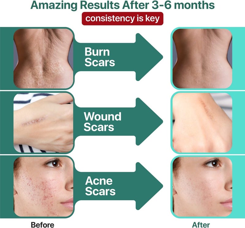 Ebanel Laboratories Ebanel Bundle of Lidocaine Numbing Cream and Advanced Silicone Scar Gel 1 Oz - Image 5