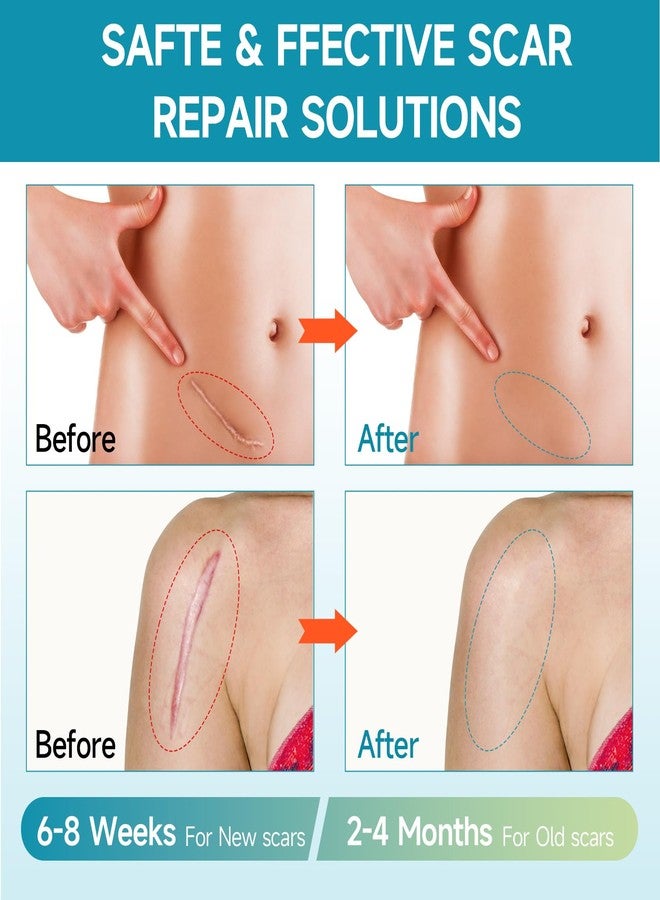 Gaayou Silicone Scar Sheets, Silicone Scar Tape (1.6"x60 " Roll-1.5M Reusable Professional Scar Silicone Strips Soft Silicone Scar Patches for Scar Removal Treatment, Surgical Scars, Keloid, C-Section, Burn - Image 5