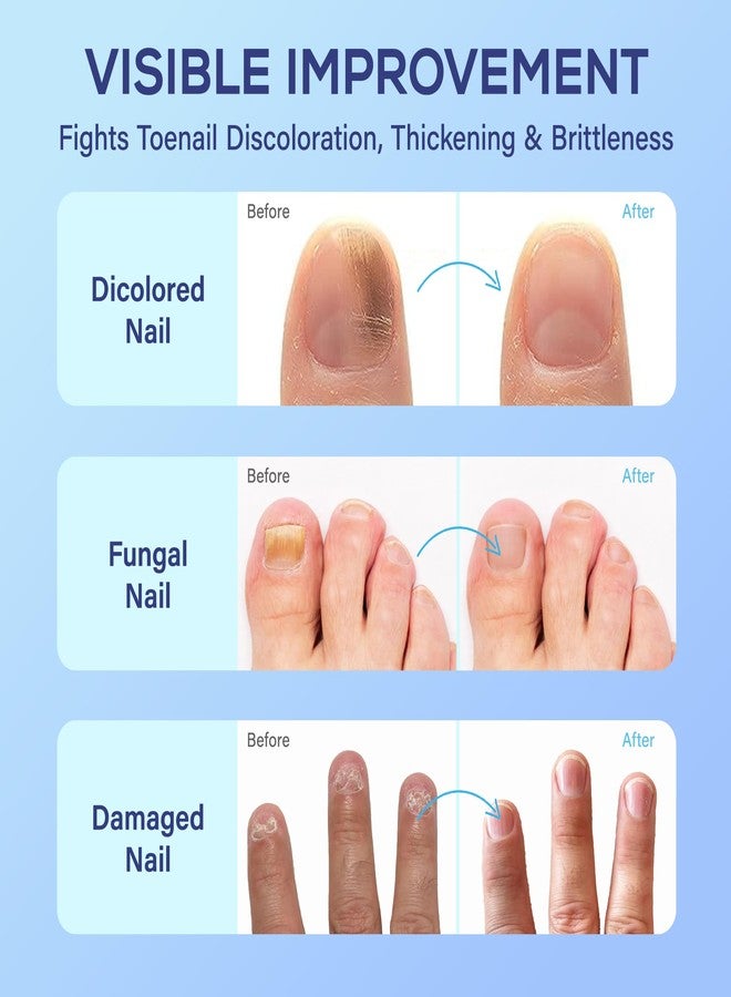 PHARMBANNER Nail Care Liquid with 25% Undecylenic Acid, 2-Pack Toe & Fingernail Appearance Care Kit with Brush Applicators & Nail File, Helps Improve the Look of Discolored, Thick & Brittle Nails - Image 4