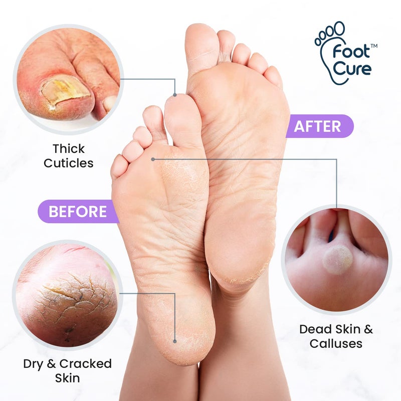 Foot Cure Lavender Foot Soak & Callus Remover Gel Kit - Extra Strength Callus Remover Gel for Feet, Remove Calluses with Epsom Salts, Dry Cracked Heels & Foot Odor, at Home Pedicure - Foot Care for Tired Feet - Image 3