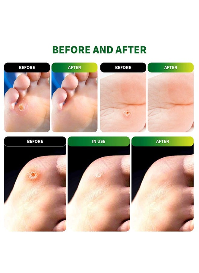 Sumifun 54 Pcs Corn Remover Pads, Foot Care Treatment for Corns u0026 Calluses, Foot Corn Removal Plaster, Relief Pain From Calluses, Corns, Blisters, Heel Rubbing  - Image 2