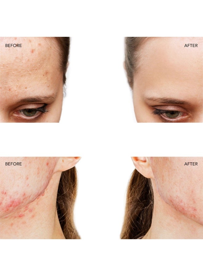 فوريو جهاز فوريو إسبادا™ 2 لعلاج حب الشباب بالضوء الأزرق لمدة 30 ثانية - لون فوشيا - وحدة واحدة - Image 3