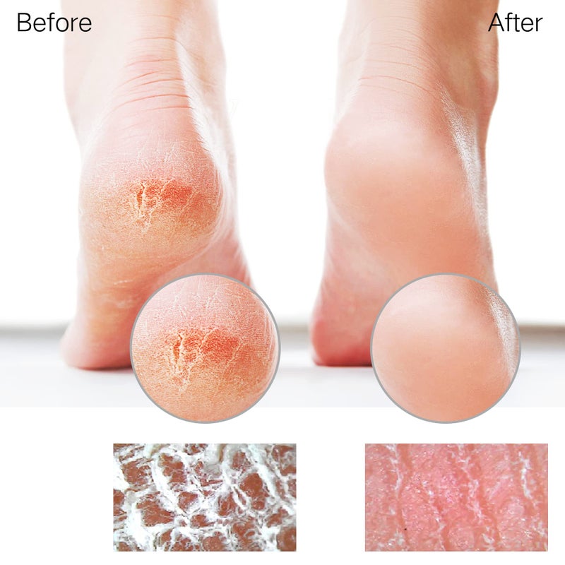 Sunivaca Glass Foot File Callus Remover for Feet, Heel Scraper, Pumice Stone, Diabetic Feet Scrubber Dead Skin Remover for Feet Professional Pedicure Tools - Image 4