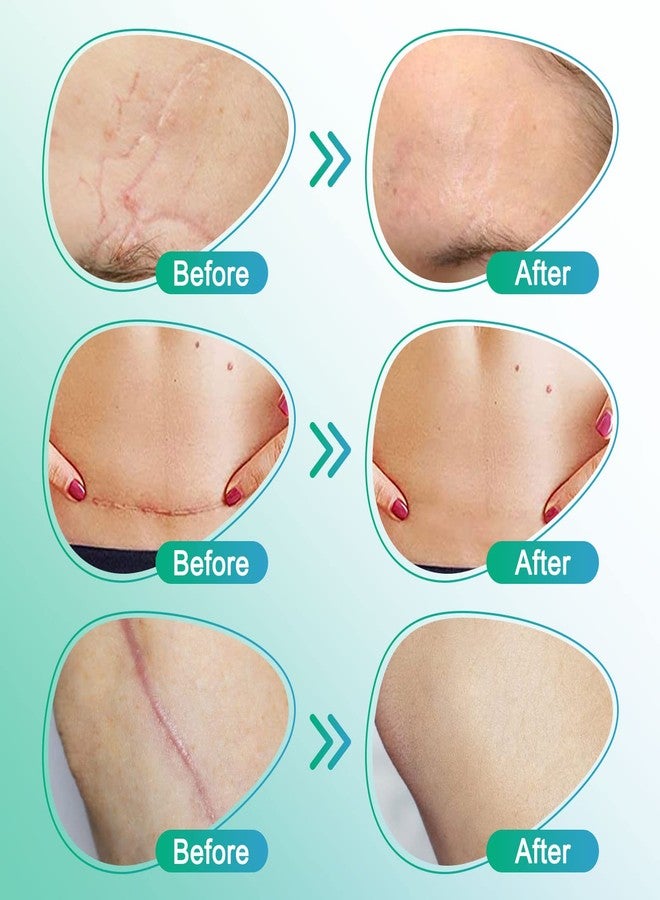 Gagaciso Silicone Scar Sheets, Silicone Scar Tape,Strips,Scar Removal Sheets,Professional Soften and Flattens Scars Caused by C-Section, Surgery, Burn, Keloid, Acne and More(1.6ââ‚¬Â x 60ââ‚¬Â) (1.6ââ‚¬Â x 60ââ‚¬Â-1.5M Roll) - Image 4