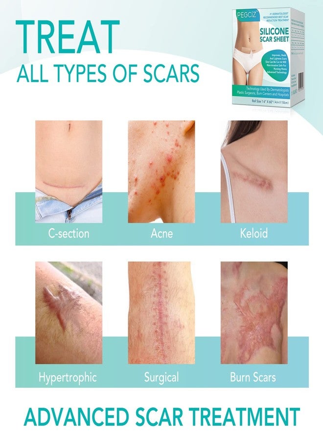 Gagaciso Silicone Scar Sheets, Silicone Scar Tape,Strips,Scar Removal Sheets,Professional Soften and Flattens Scars Caused by C-Section, Surgery, Burn, Keloid, Acne and More(1.6ââ‚¬Â x 60ââ‚¬Â) (1.6ââ‚¬Â x 60ââ‚¬Â-1.5M Roll) - Image 5