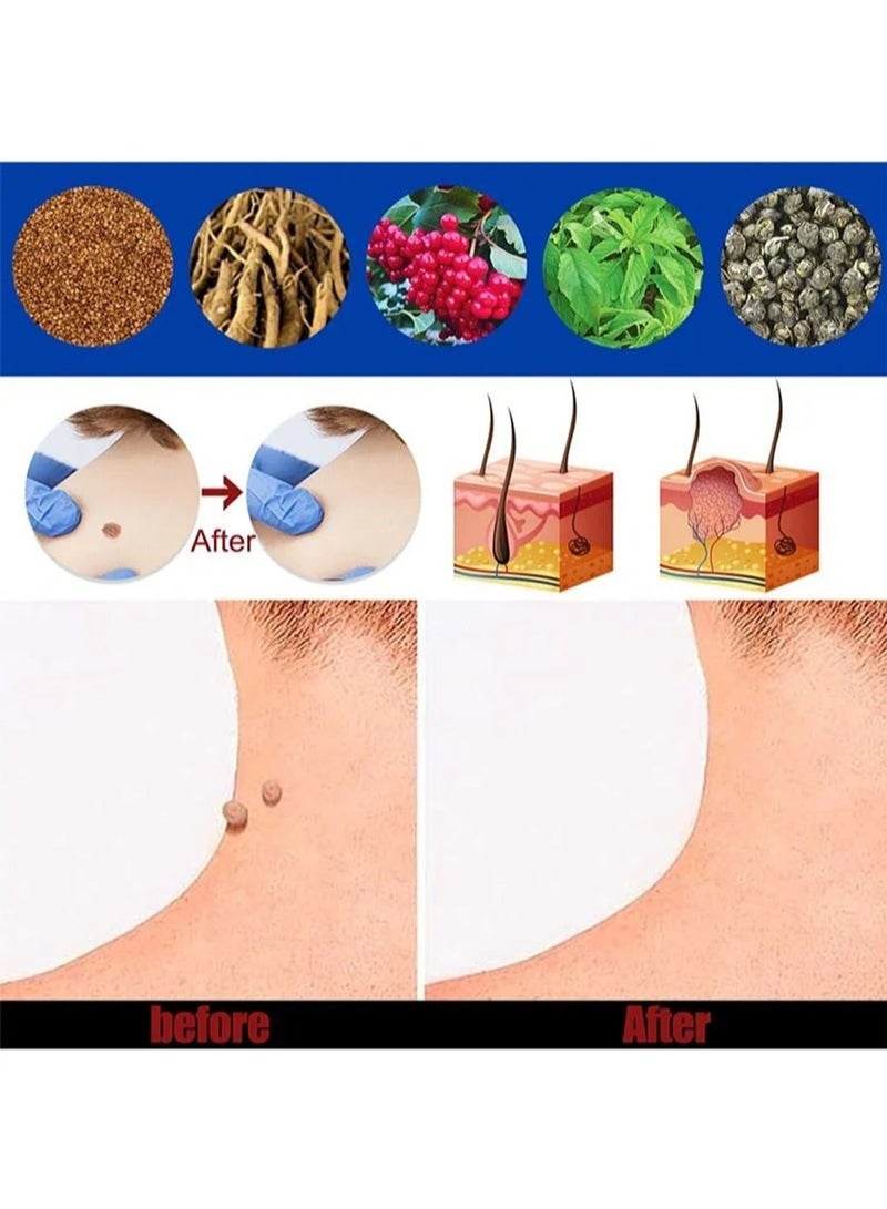 SOUTH MOON مرهم إزالة الثآليل، كريم إزالة الثآليل المحمول اللطيف والآمن مع مستخلصات طبيعية لجميع أنواع البشرة - Image 5