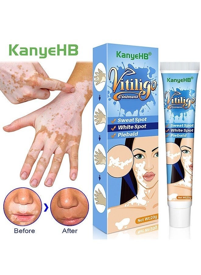 KanyeHB Vitiligo Ointment, Vitiligo Treatment For Skin Vitiligo, Vitiligo Care Cream For Reduce White Spots And Improve Skin Pigmentation 20G - Image 1