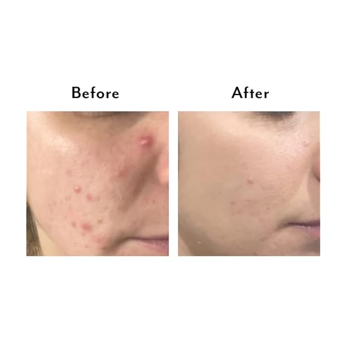 Lavido - Natural Thera Intensive Clarifying Spot Treatment | Balance, Clarify + Soothe Breakout-Prone Skin (1.01 oz | 30 mL) - Image 5