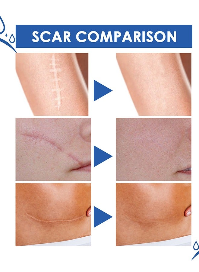 Jaysuing Scar Removal Cream - Acne Scar Cream Rapid Repair Scar Cream for Acne Surgery Injury Burns Advanced Gel Acne Scar Spot Treatment Suitable for All Skin Types 30g - Image 5