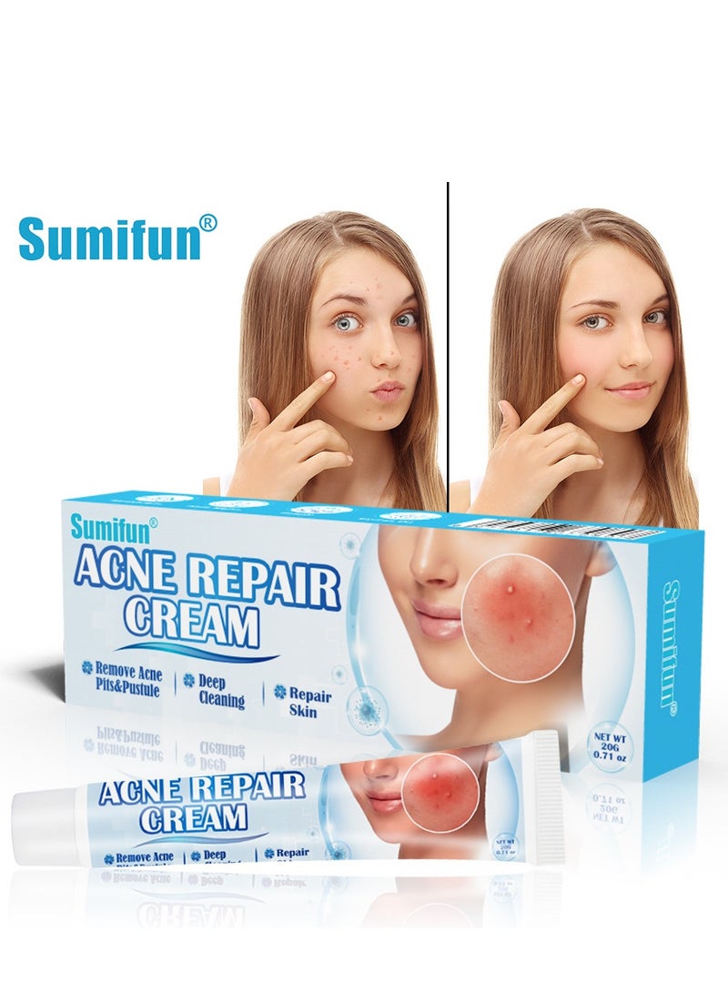 سوميفون علاج حب الشباب، كريم إزالة حب الشباب، يعمل على إصلاح حفر حب الشباب، تفتيح علامات حب الشباب وكريم إزالة البقع، يرطب ويقلص المسام، للاستخدام ليلاً ونهارًا، 20 جم - Image 1