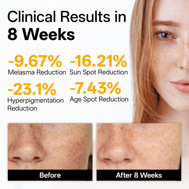 WNP Vitamin C Serum for Face - Dermatologist Tested Anti-Aging & Brightening with Hyaluronic Acid & Vitamin E, Treatment for Dark, Age, Sun Spot, Melasma, Hyperpigmentation, Fine Lines & Wrinkles - Image 2
