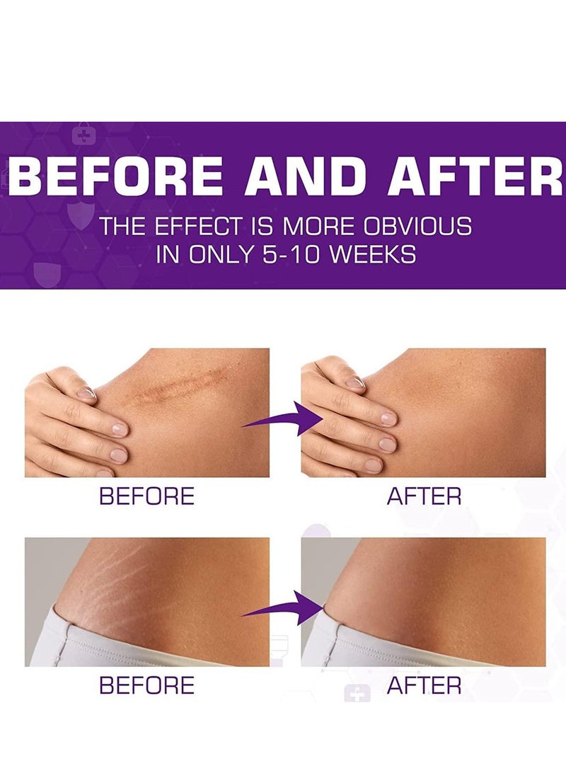 HBESTY Skin Scar Cream，Body Scar Removal，Silicone Scar Gel, Scar Cream，Scar Gel，Acne Scar Treatment，Deep Acne Scar Removal， Burns Keloids Hypertrophic， Scar Removal Cream， Repair Damaged Skin，Removing Acne Marks, Scar Repair Cream ﻿  - Image 5