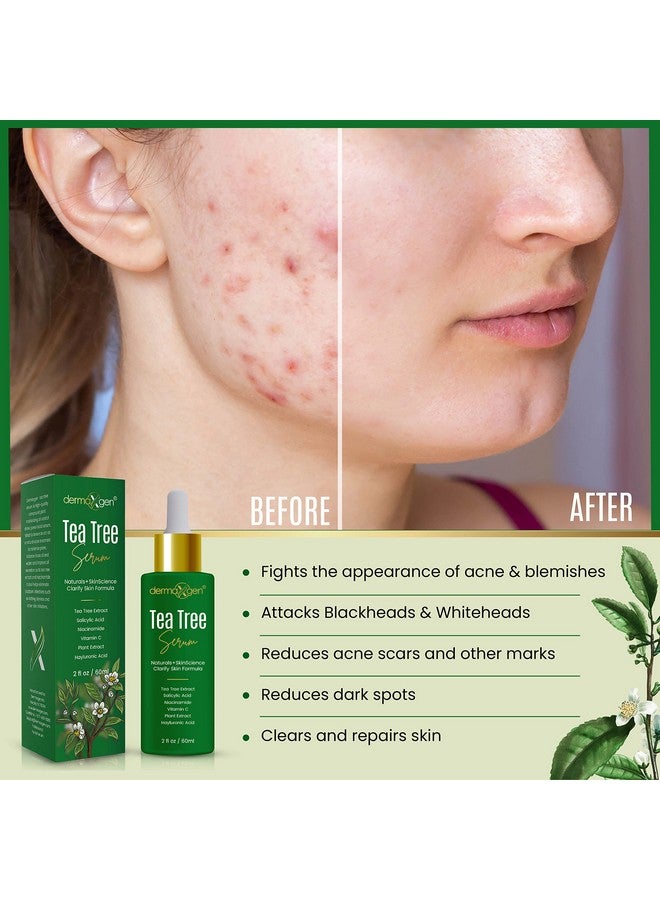 dermaxgen Tea Tree Serum Organic Formula Natural Vitamin C For Acne Scar Dark Spots Blemishes Pimple For Clear Glowing & Youthful Skin 2 Fl Oz - Image 5