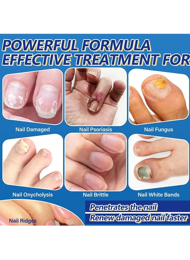 West&Month Nail Repairing Liquid - Speedy and Effective Approach to Toenail Issues - Combating Thick, Discolored Nails - Powerful Solution for Addressing Yellow and Brown Nails - for Thick, Broken, Discolored & Damaged Nail - 30ML - Image 5
