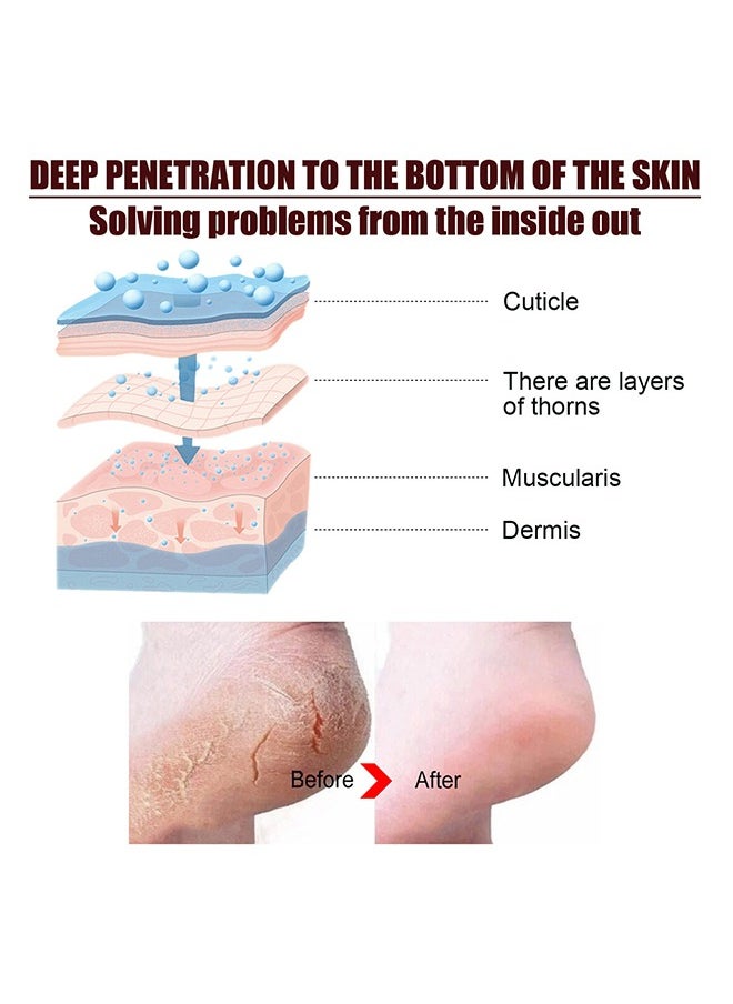 ISSUWEN - Urea Cream 42% And Salicylic Acid 2%, Foot Cream For Dry Cracked Heels Knees Elbows Hands Repair Treatment, Foot Moisturizer Corn Callus Dead Skin Remover Toenail Softener For Foot Care 100g - Image 1
