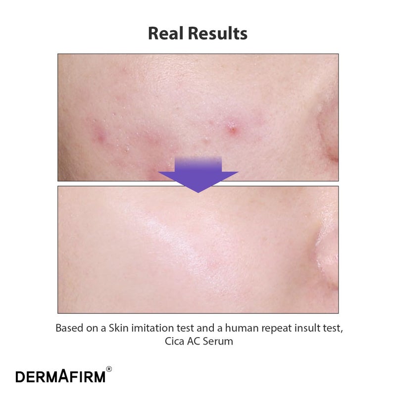 DERMAFIRM CICA AC Serum for Acne-Prone Skin â€“ Korean Facial Serum with Exosome, Centella Asiatica, Niacinamide, Salicylic Acid & Vitamin B3 â€“ Hydrating & Calming, 1.01 fl oz - Image 2