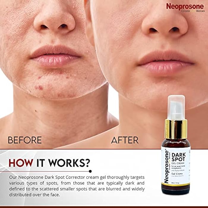 Neoprosone نيوبروسون، مزيل البقع الداكنة للوجه - 1 أونصة سائلة / 30 مل - كريم تفتيح، يقلل من العيوب، بقع الشمس، البقع البنية على: الوجه، الركب، المرفقين، اليدين، المناطق الخاصة - Image 4