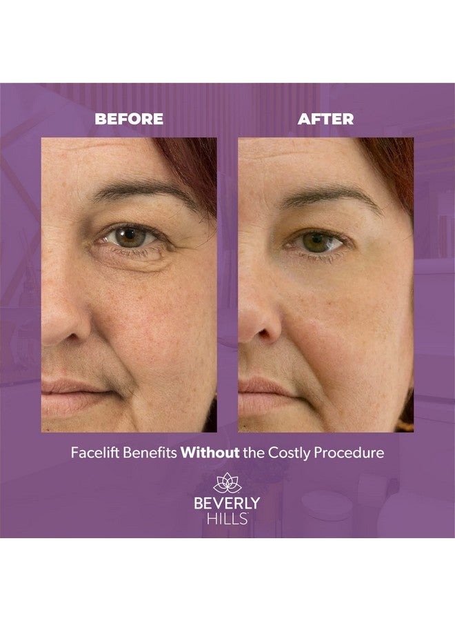 Beverly Hills Vlift Instant Eye Lift And Eye Tuck Bee Venom Serum For Puffy Eyes, Dark Circles, Wrinkles, And Under Eye Bags Treatment For Women And Men | 30Ml (120 Day Supply) - Image 5