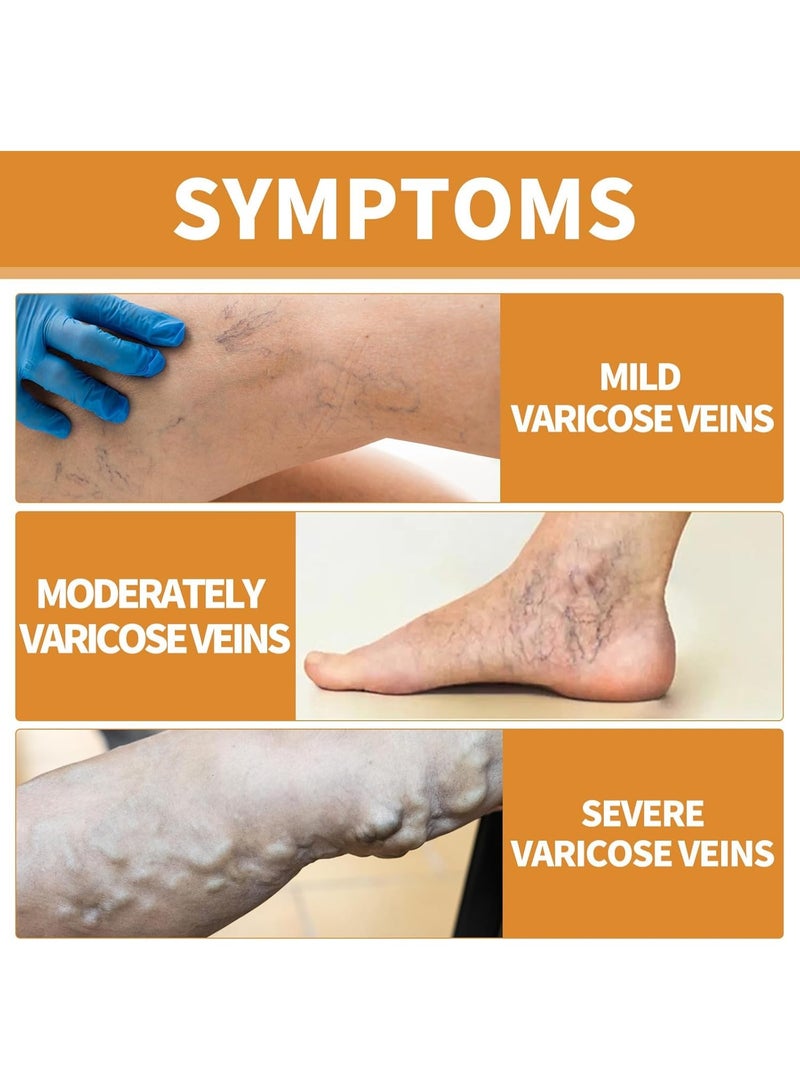 ساوث مون مجموعة علاج دوالي الساقين: رذاذ لتحسين الدورة الدموية بسعة 30 مل، 12 قطعة من معجون تخفيف دوالي العروق، وكريم للساقين بوزن 30 غ لتقليل التورم والألم. - Image 5
