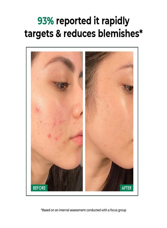 Conscious Chemist® Acne Care Duo | Spot Corrector Gel & Microneedle Acne Patches | Helps Improve Skin Clarity | With 2% Salicylic Acid, 2% Azelaic Acid & 3.3% Niacinamide | For Oily & Acne-Prone Skin | Pack of 2 - Image 1