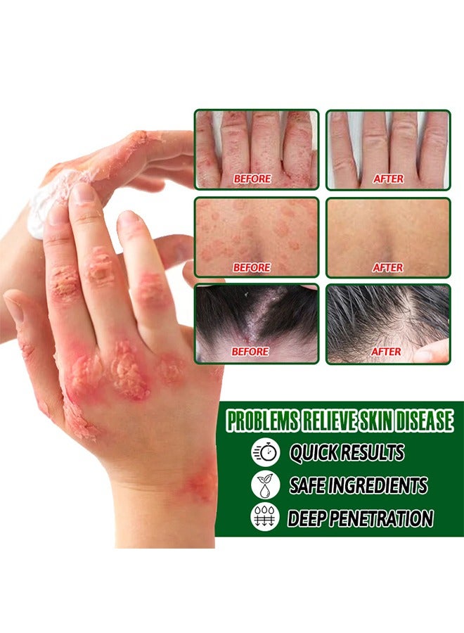 سوميفون كريم الصدفية - كريمات الصدفية العشبية الصينية الطبيعية ، التهاب الجلد والأكزيما الحكة مرهم الصدفية ، كريمات الصدفية ، علاج الصدفية ، كريم مضاد للبكتيريا ، لحكة الجسم 20 جرام - Image 2