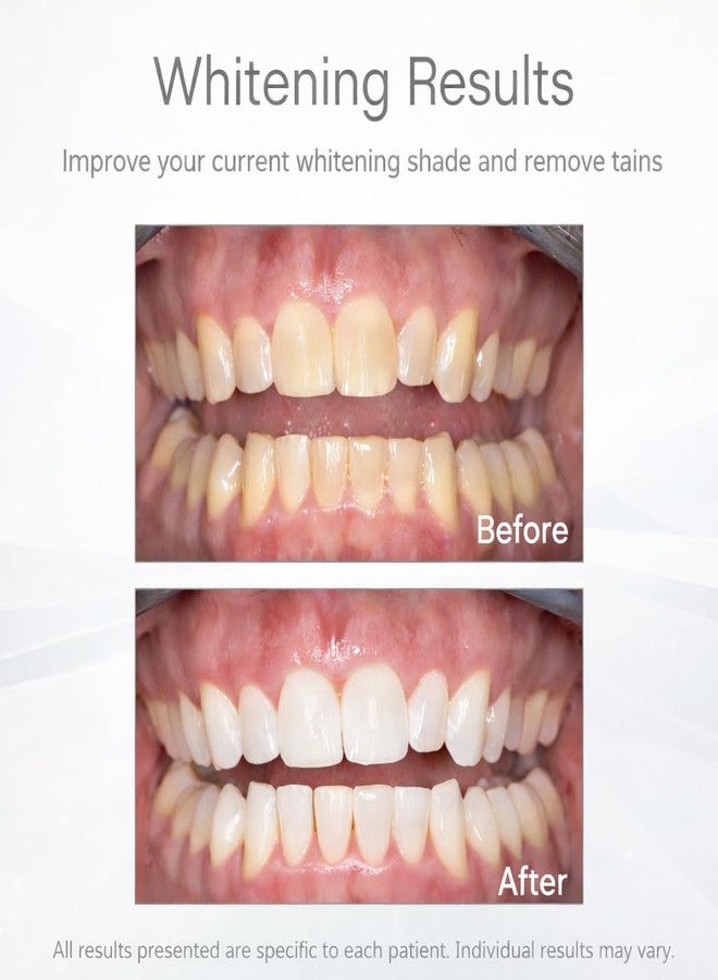 Opalescence Go 10% - Prefilled Teeth Whitening Trays Kit (10 Treatments - Hydrogen Peroxide - Mint - by Ultradent Products. Go Teeth Whitening Kit -Mint- Includes Toothbrush -5193-GO10-TB - Image 3