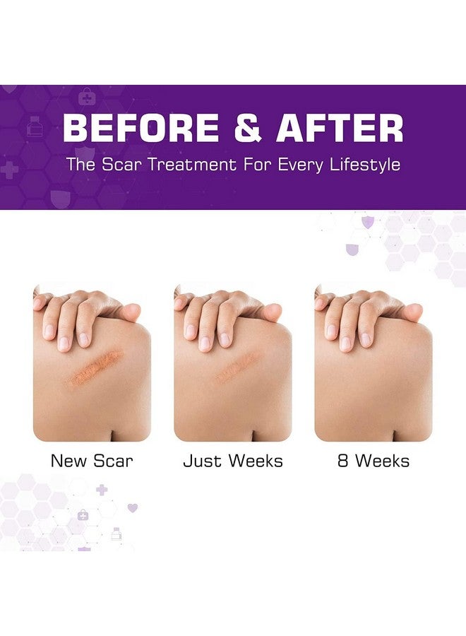 Kelinul Silicone Scar Sheets(1.6 X 120"Roll) Scar Removal Silicone Scar Tape For Softening And Flattening Scars, Acne, C-Section, Keloid Surgery, Painless Removal, Reusable, Washable, 12 Month Supply - Image 2