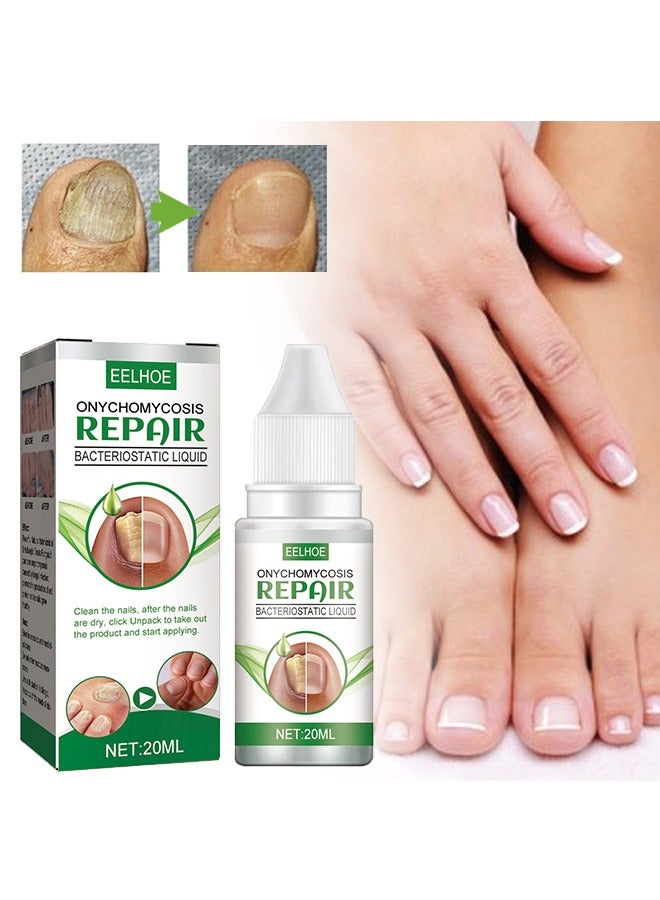 EELHOE Onychomycosis Repair Bacteriostatic Liquid，Nail Repair treatment Liquid Nail Fungus Treatment for Damaged Nails Onychomycosis Fungal Nail 20ml - Image 1