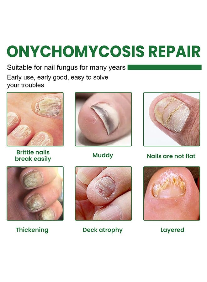 EELHOE Onychomycosis Repair Bacteriostatic Liquid，Nail Repair treatment Liquid Nail Fungus Treatment for Damaged Nails Onychomycosis Fungal Nail 20ml - Image 4