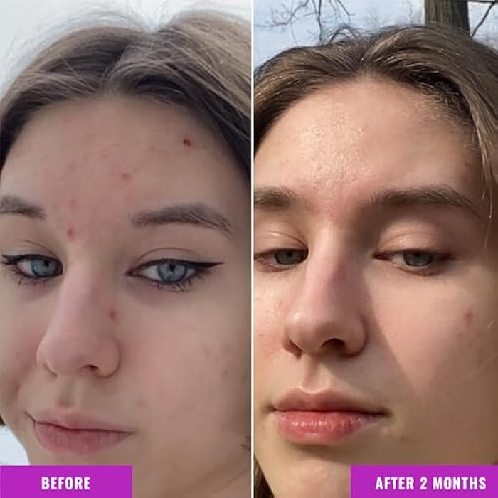 Good Molecules Niacinamide Serum - 10% Niacinamide to Target Acne, Nourishment, and Skin Tone - Ultra Hydrating Serum and Brightening Skin Care for Face - Image 4