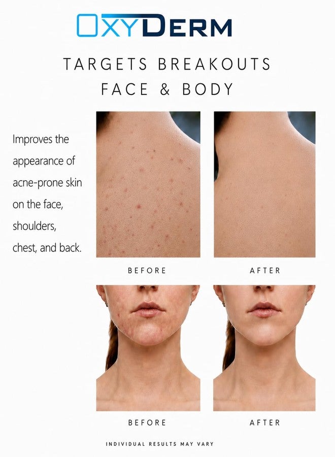 OxyDerm Acne Spot Treatment Face & Body – Invisible Natural Non-drying Formula Fights Cystic Acne, Pimples, Breakouts, Zits, Whiteheads & clogged pores. Fade Away Dark Spots & Acne Scars. For All Skin Types. - Image 4