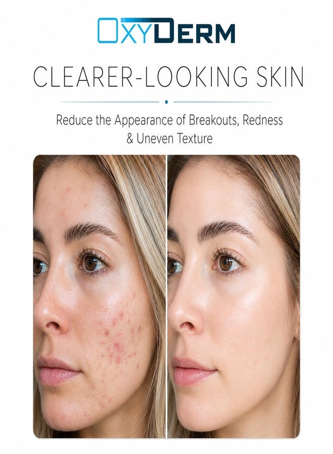 OxyDerm Acne Spot Treatment Face & Body – Invisible Natural Non-drying Formula Fights Cystic Acne, Pimples, Breakouts, Zits, Whiteheads & clogged pores. Fade Away Dark Spots & Acne Scars. For All Skin Types. - Image 3