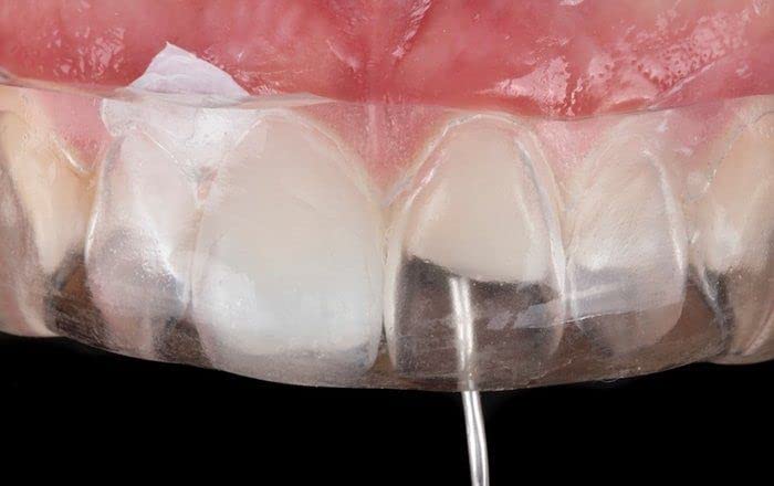 WALDENT والدينت الكيميائي نانوفلو زركونيوم المركب السائل | درجة اللون B1 | 2 جرام حقنة | قوة عالية ومقاومة للتآكل | مادة ترميم الأسنان - Image 4