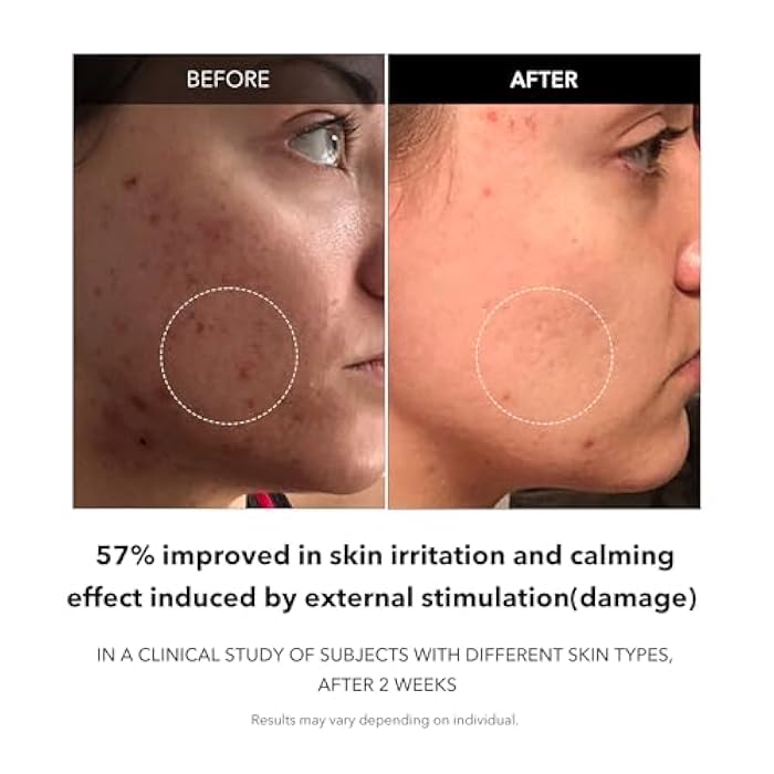 APRILSKIN Carrotene Clarifying Facial Serum | Vegan, Non-comedogenic | Blemish Clear, Dark Spot Corrector | Korea Skincare | Oily Skin, Sensitive Skin, Bumpy Skin | 1.25 fl.oz - Image 4