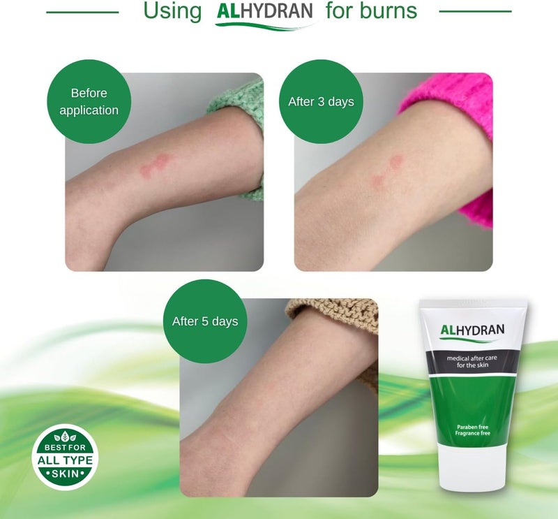 Alhydran After Care for The Skin Scars Dry Skin Eczema Itching Burn Wounds and Skin Problems After Radiotherapy or Surgery 250ml - Image 5