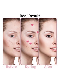 SYOSI Heart-Shaped Pimple Patches for Acne Treatment, Love Heart Acne Spot Patches Pimple Solution Pink Love Heart Patches Spot Patches  with Niacinamide and Hyaluronic Acid for Moisturizing, Blemish Spot  - Image 5