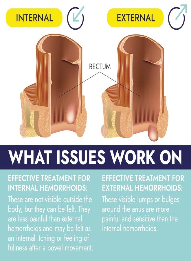 Terramed Just Think Comfort Hemorrhoid Suppository for Pain, Burning & Itching Relief | Effective Hemorrhoid Treatment for Swelling, Irritation & Discomfort | Soothes & Supports Recovery for Lasting Comfort | 24 Suppositories - Image 2