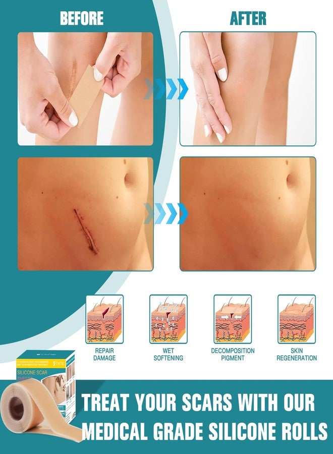 Nine Silicone Scar Sheets (1.6”x120" Roll-3M),Silicone Scar Tape Roll,Scar Silicone Strips,Ultra-thin Scar Removal Treatment for Surgical Scars, C Section, Tummy Tuck, Keloid Bump Removal - Image 4
