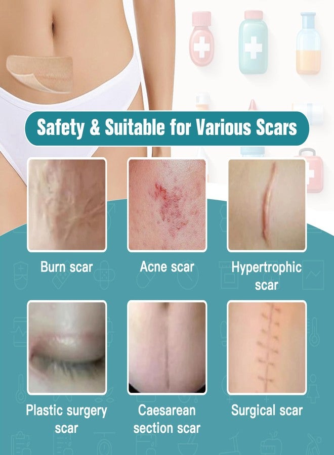 Nine Silicone Scar Sheets (1.6”x120" Roll-3M),Silicone Scar Tape Roll,Scar Silicone Strips,Ultra-thin Scar Removal Treatment for Surgical Scars, C Section, Tummy Tuck, Keloid Bump Removal - Image 3