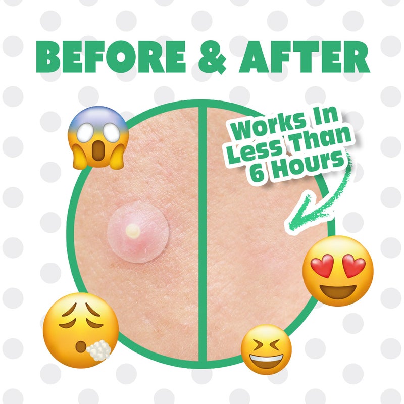 EBIN NEW YORK Pimple Buster Tea Tree Hydrocolloid Acne Patches for Face, 128 Pack (10mm, 12mm, 14mm), Absorb Zits, Shield Spot, All Skin Types - Image 3