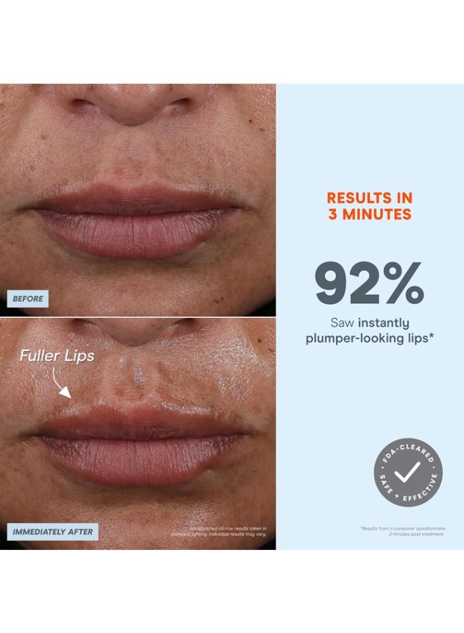 Nuface جهاز نوفيس FIX مايكرو واند للعناية بالوجه بتقنية المايكروكرنت - علاج للعيون، الشفاه والخطوط مع مُنشط السيروم - أداة لتكبير الشفاه وتقليل الانتفاخ تحت العينين وتقليل التجاعيد وخطوط الابتسامة مع 3 أوضاع متنقلة - Image 2