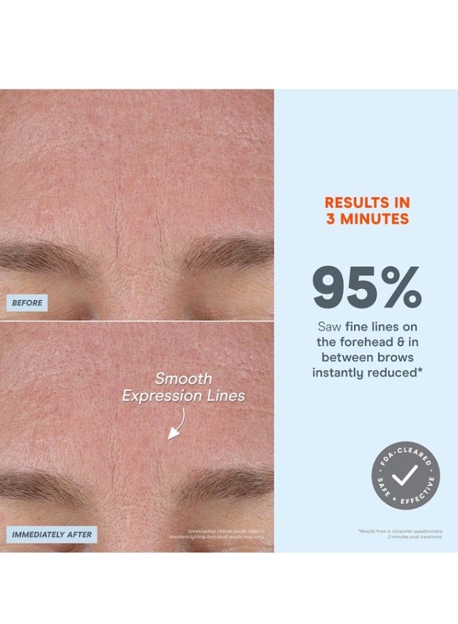 Nuface جهاز نوفيس FIX مايكرو واند للعناية بالوجه بتقنية المايكروكرنت - علاج للعيون، الشفاه والخطوط مع مُنشط السيروم - أداة لتكبير الشفاه وتقليل الانتفاخ تحت العينين وتقليل التجاعيد وخطوط الابتسامة مع 3 أوضاع متنقلة - Image 4