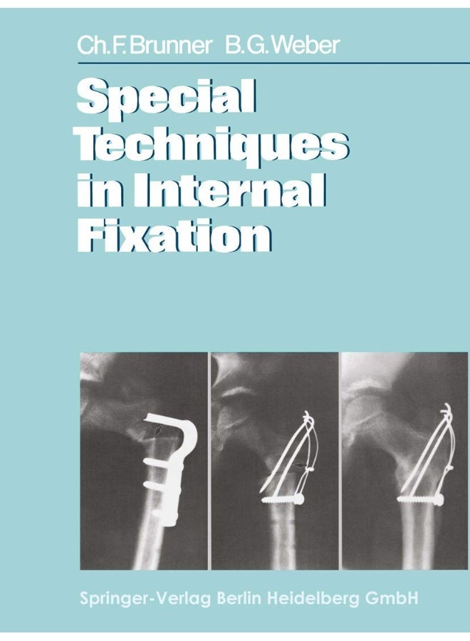 Special Techniques in Internal Fixation 